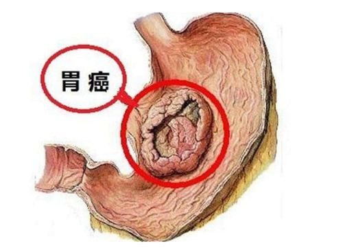 癌症柠檬精油可以吃吗 癌症柠檬精油可以吃吗