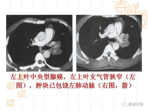 ��֢�Ͷ�������һ����