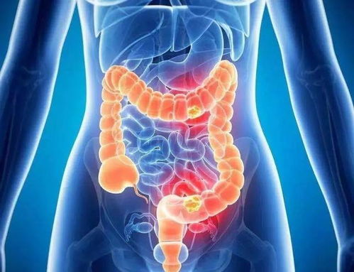 腿窝后面疼是癌症前兆吗 腿窝后面疼是癌症前兆吗