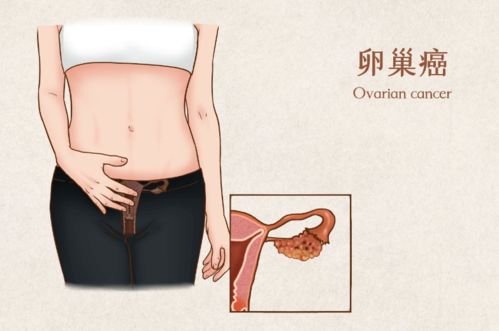 引起癌症的叫什么癌症 引起癌症的叫什么癌症